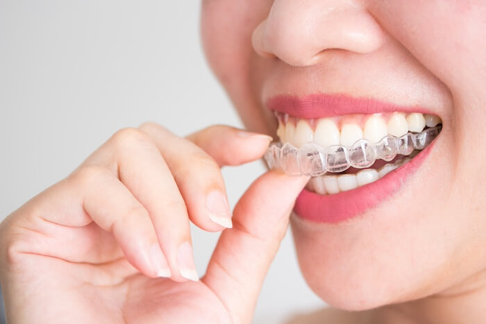 Boost Confidence with Invisalign’s Invisible Braces